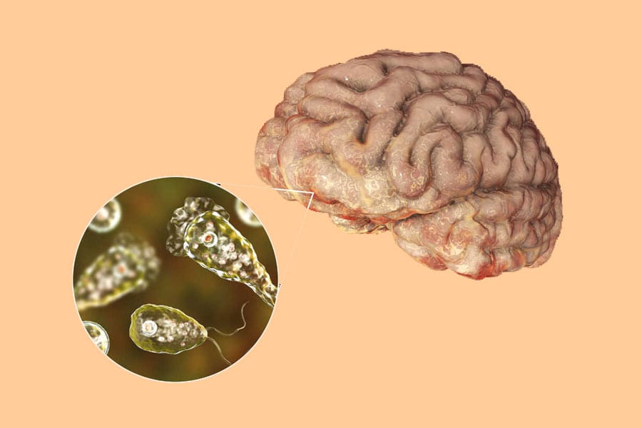 അമീബിക് മസ്തിഷ്‌ക ജ്വരം