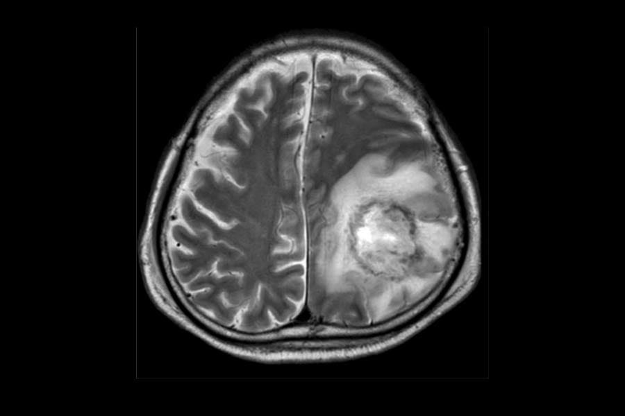 amoebic-meningoencephalitis അമീബിക് മസ്തിഷ്ക ജ്വരം സ്ഥിരീകരിച്ച ഒരാൾ കൂടി മരിച്ചു